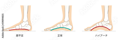 足のアーチの正常と異常