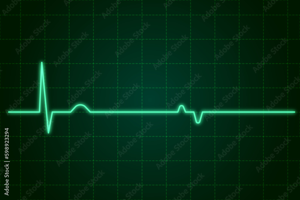 EKG monitor in intra aortic balloon pump machine in icu on blur background, Brain waves in electroencephalogram, heart rate wave EKG monitor in intra aortic balloon pump machine in icu on blur background, Brain waves in electroencephalogram, heart rate wave