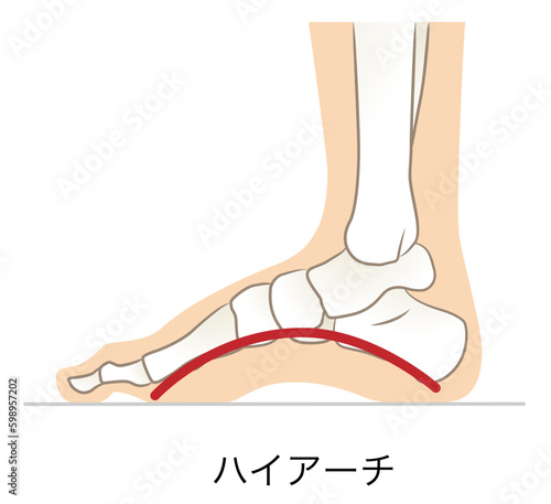 アーチが高すぎる足、ハイアーチの足
