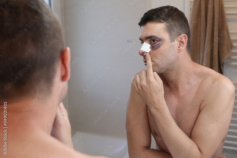 Man recovering from a rhinoplasty Man recovering from a rhinoplasty