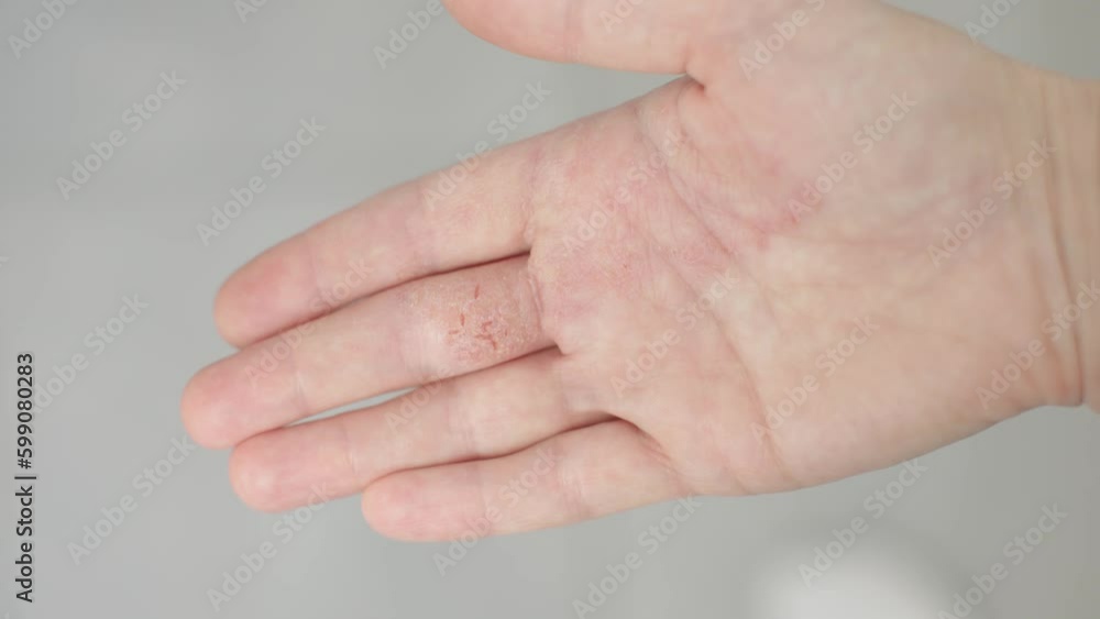 dermatitis, psoriasis eczema and dry skin of palm hands, itchy inflammatory condition. round spots, coin-shaped lesions, small blisters and cracks occur discoid eczema. dermatological Generative AI dermatitis, psoriasis eczema and dry skin of palm hands, itchy inflammatory condition. round spots, coin-shaped lesions, small blisters and cracks occur discoid eczema. dermatological Generative AI