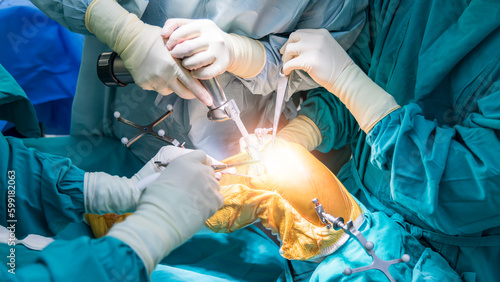 Doctor or surgeon in blue gown used robotic navigator total knee joint arthroplasty surgical instrument inside operating room.Medical technology in orthopedic surgery.Hand of people with a saw.