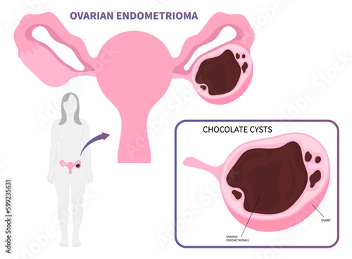 In Vitro Fertilization or IVF with chocolate cyst Ovarian Endometrioma cancer tumor endometriosis uterus Polycystic Ovary Syndrome