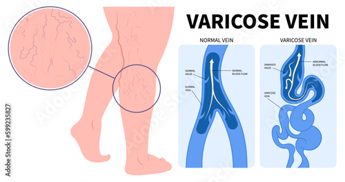 Cramps Limb Injury Phlebectomy of Vascular Artery Disease Medical Anatomy Varicose Vein or Endovenous Laser Venous and Valves Knee Heart Foot Calf Treat Flow Thigh Socks High Sores Aching