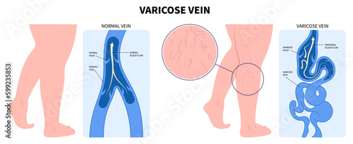 Artery Disease Medical Foot Calf Aching Injury Treat Varicose Vein or Phlebectomy Anatomy Endovenous Laser Vascular Venous and Knee Heart Flow Thigh Socks High Valves Cramps Limb Sores