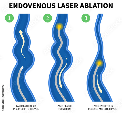 Varicose vein Phlebectomy Artery Disease Medical Anatomy Endovenous Laser Vascular Venous and Knee Heart Foot Calf Treat Flow Thigh Socks High Valves Cramps Limb Sores Aching Injury