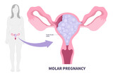 Miscarriage ectopic trophoblasts disease pregnancy or Hydatidiform Molar mole fetus placenta complete partial fluid filled cysts cancer bleeding vagina fertilize of HCG level and D&C test egg loss