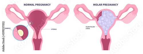 Obraz na płótnie Molar pregnancy or Hydatidiform mole trophoblasts disease ectopic fetus placenta