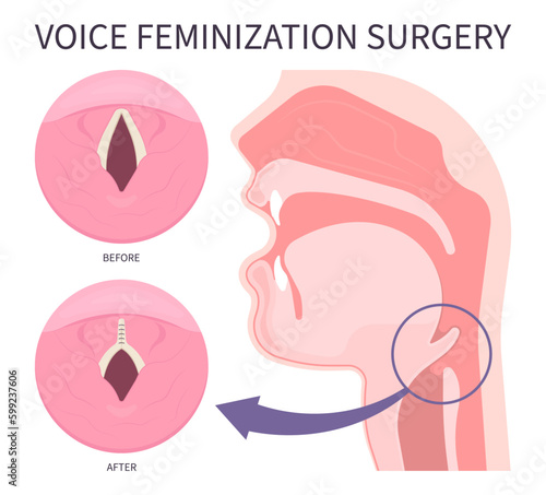 Medical anatomy for Voice Feminization Surgery male to female of Adam's procedure face speech estrogen exercise affirming care