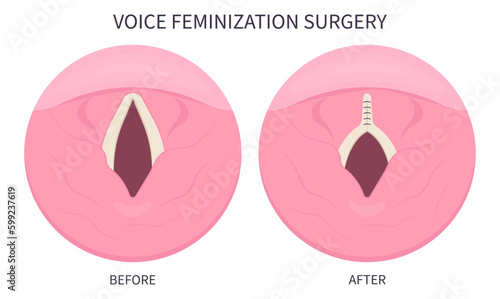 Voice Feminization Surgery male to female of Adam's procedure face speech estrogen exercise affirming care photo