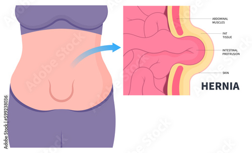 belly button umbilical hernia stomach abdominal pain small large intestine constipation or inguinal incisional Femoral diastasis recti ileus lump navel wall cavity baby infant birth volvulus Hiatus