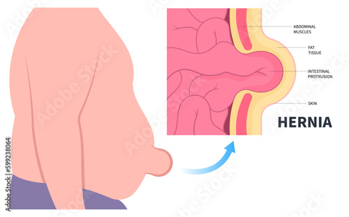 stomach abdominal pain small large intestine constipation belly button umbilical hernia or inguinal incisional Femoral diastasis recti ileus lump navel wall cavity baby infant birth volvulus Hiatus photo