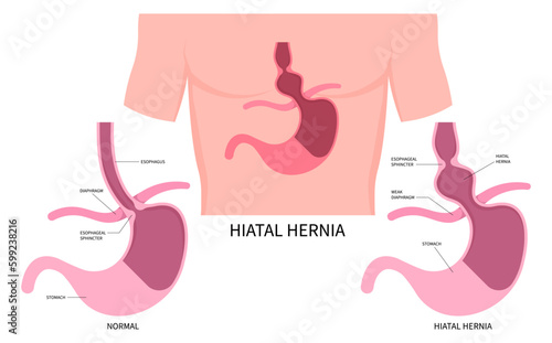 Difficulty swallowing esophagus or Dysphagia GERD exam Hiatal Hernia Stomach Heartburn bulges abdomen Nissen fundoplication acid gastroesophageal reflux esophagitis abdominal treat Barrett’s Disease