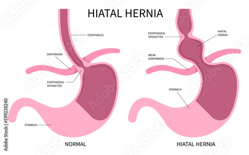 Stomach Heartburn Difficulty swallowing esophagus or Dysphagia GERD exam Hiatal Hernia bulges abdomen Nissen fundoplication acid gastroesophageal reflux esophagitis abdominal treat Barrett’s Disease photo