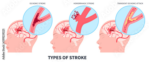 Brain attack damage frontal lobe of Stroke vascular dementia Hemorrhagic transient ischemic Alzheimer's heart pill mini risk signs symptom care Fatty deposits High and TIA arm face memory blockages