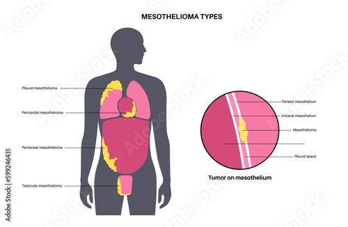 Mesothelioma tumor types