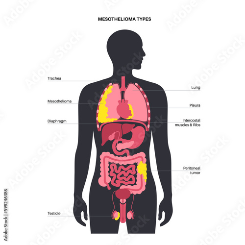 Mesothelioma tumor types