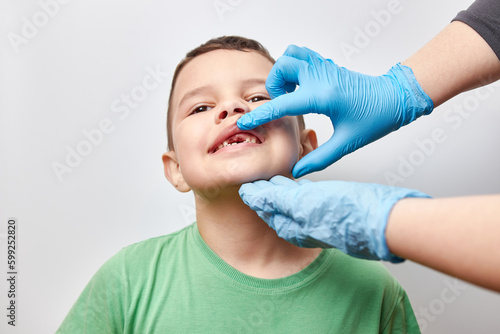 Examination of the oral cavity of a boy with missing milk teeth. Loss of milk teeth in children.