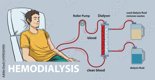 illustration of hemodialysis diagram