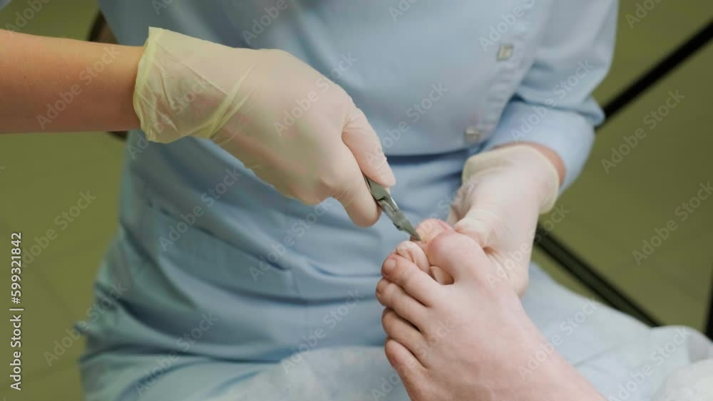 Removal of the keratinized layer of skin from the nail with forceps. Podology and nail care Removal of the keratinized layer of skin from the nail with forceps. Podology and nail care