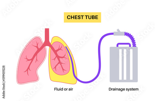 Chest tube catheter