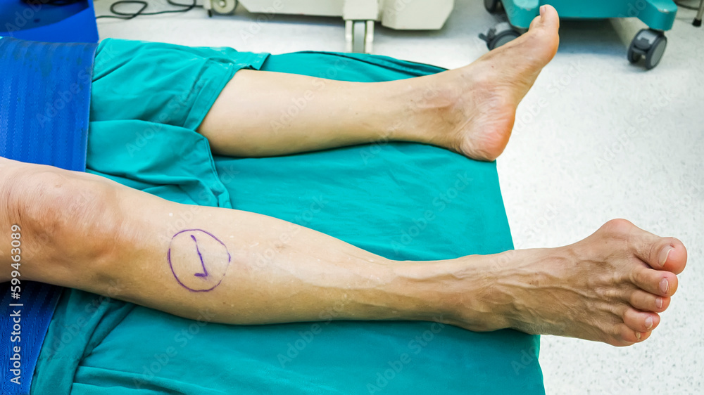 Check mark at right leg inpatient inside operating room.Hallux valgus or bunion surgery.Patient safety and wrong site procedure.Lawsuit and insurance.Medical concept.