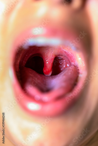 Fotografía open wide mouth with swollen uvula showing inside