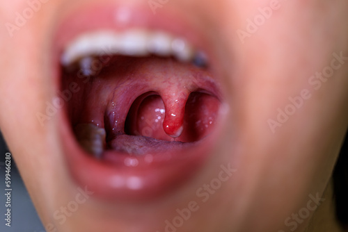 open wide mouth with swollen uvula showing inside photo