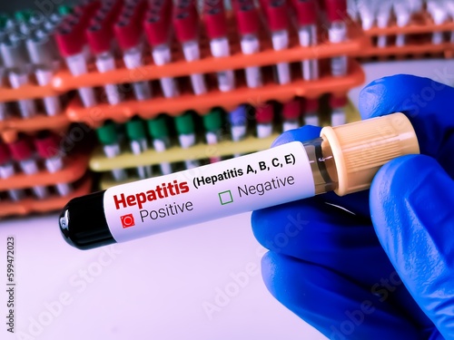 Scientist hold blood sample for Hepatitis virus (Hepatitis A, B, C, E) test. photo