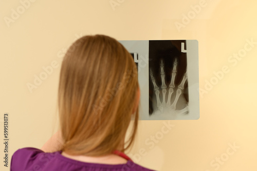 pani doktor ortopeda ogląda zdjęcie rentgenowskie rtg, prześwietlenie dłoni 