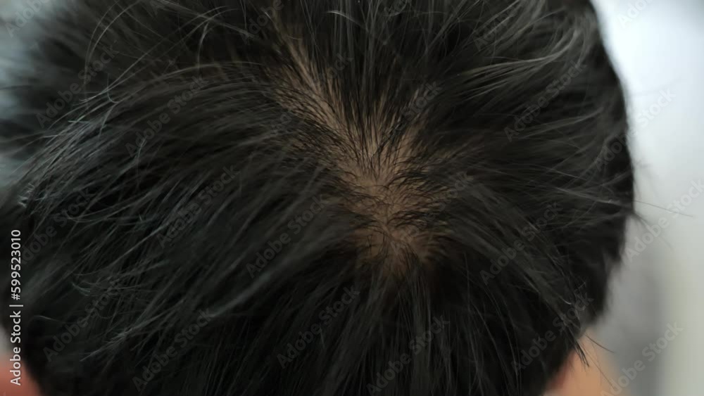 The beginning of baldness on the head of Asian man The beginning of baldness on the head of Asian man