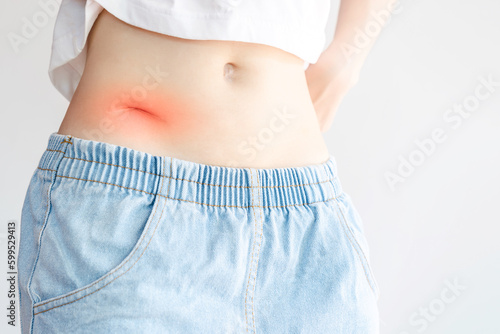 Women's scars caused by abdominal surgery, such as appendicitis. Health care concept.