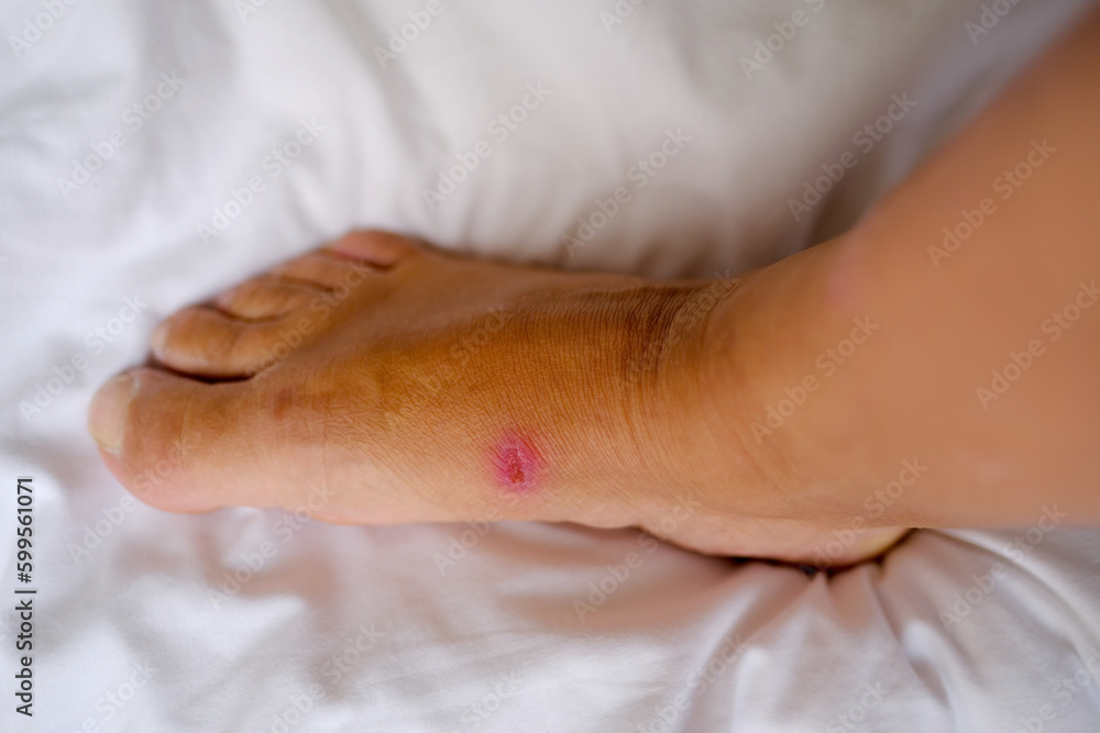 closeup of weeping wound, thermal burn, trophic ulcer on female leg closeup of weeping wound, thermal burn, trophic ulcer on female leg