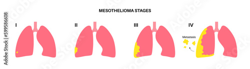 Mesothelioma cancer stages