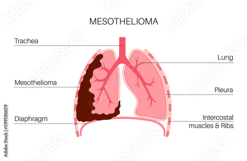 Mesothelioma cancer disease