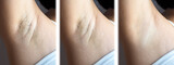 Asian woman showing her underarms Before and after pictures of hair removal on the armpits and after underarm chicken skin removal increase confidence in women