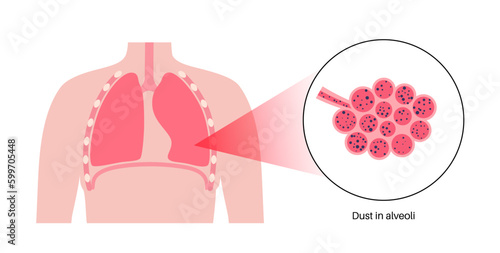 Pneumoconiosis lung disease
