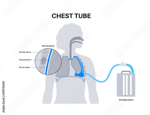 Chest tube catheter photo