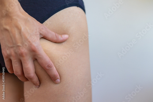 Stretch marks on female legs. A woman's hand holds a fat cellulite and a stretch mark on her leg. .