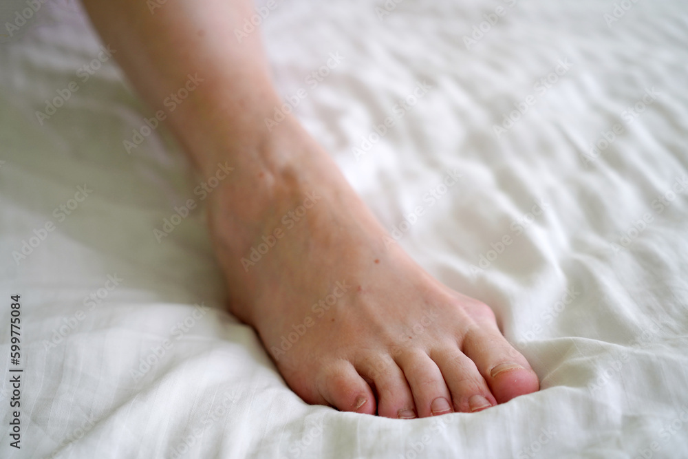 female legs with problem with women's feet, bunion toes in bare feet. Hallus valgus female legs with problem with women's feet, bunion toes in bare feet. Hallus valgus