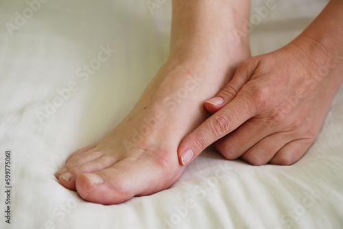 female legs with problem with women's feet, bunion toes in bare feet. Hallus valgus photo