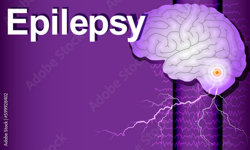 Epilepsy. Brain and encephalography in epilepsy patient during seizure attack, epilepsy activity. Vector illustration in violet color. 