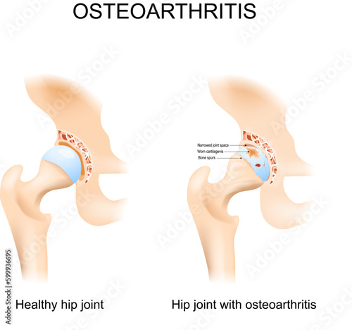 Hip joint with osteoarthritis