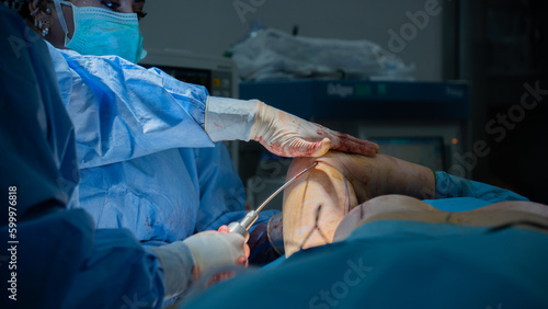 arm lift surgery. Doctor doing liposuction for fat on woman's arm in arm lift surgery  photo