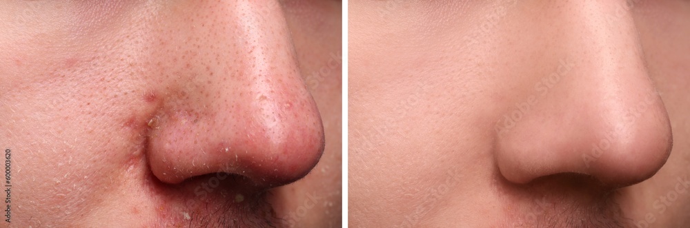 Fototapeta premium Photos of man before and after acne treatment, closeup. Collage showing affected and healthy skin