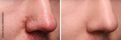 Canvastavla Photos of man before and after acne treatment, closeup