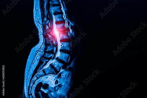 Blue tone radiograph on black background in hospital.Doctor used xray for diagnosis of the back bone pain of patient.MRI technology in spine or spinal stenosis with red light.Medical and orthopedic.