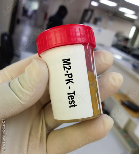 Stool sample for M2-pyruvate kinase(M2-PK) Test, is a non-invasive stool test, used to early detection of colorectal cancers and polyps, precursors of colorectal cancer. photo