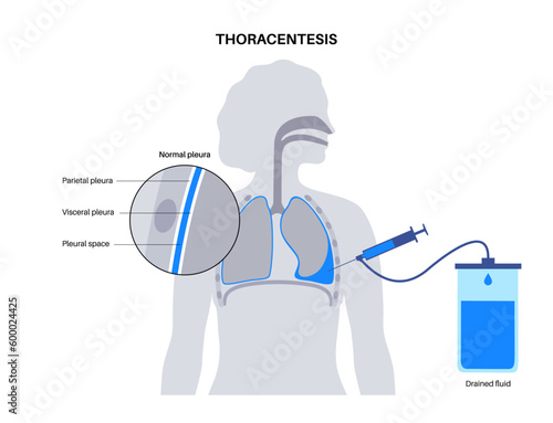 Thoracentesis medical procedure