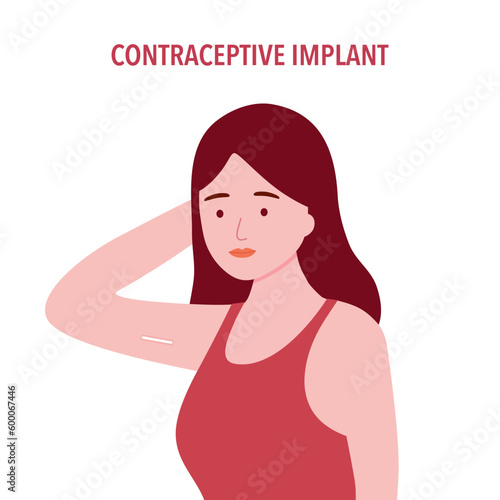 Contraceptive implant underneath female skin in flat design on white background. Birth control.